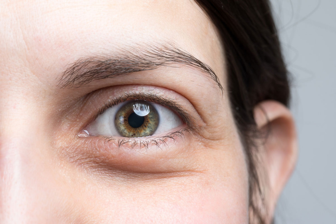 Как можно быстро убрать синяк под глазом?