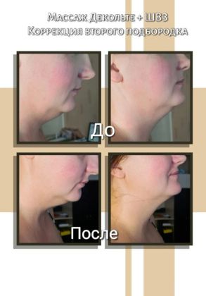 Массаж зоны декольте и швз 