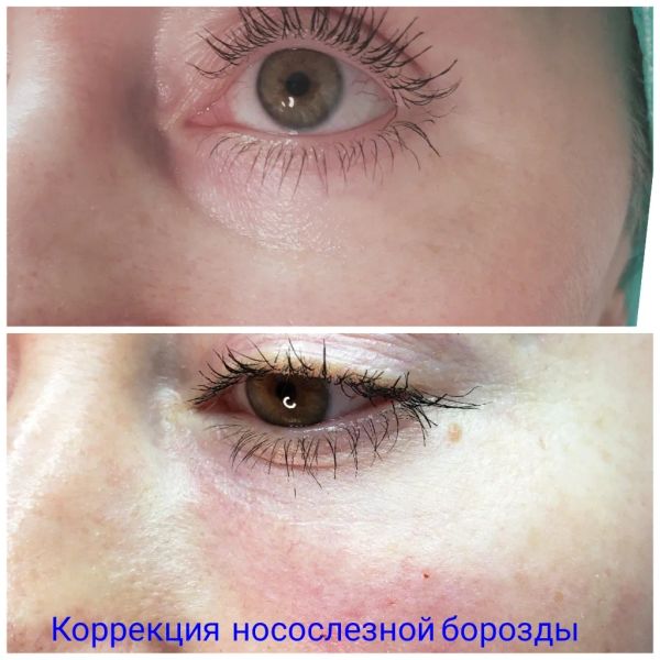 Коррекция носослезной борозды