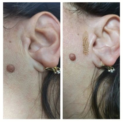 Околоушные морщины. 