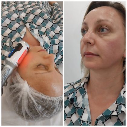 Подтяжка лица на аппарате сфера 