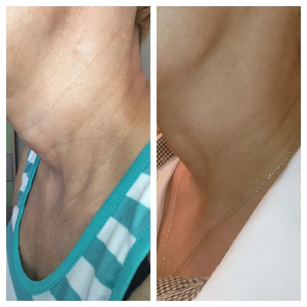 Подтяжка кожи шеи, результат через месяц 1 процедура 