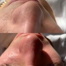 8 этапная ультразвуковая чистка лица 