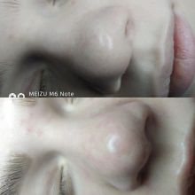 до и после процедуры (нос) 
