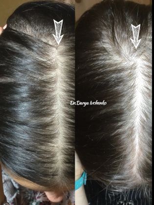 Лечение выпадения волос, слева «симптом елочки», справа - пошёл процесс, часть пробора нормализовалась
