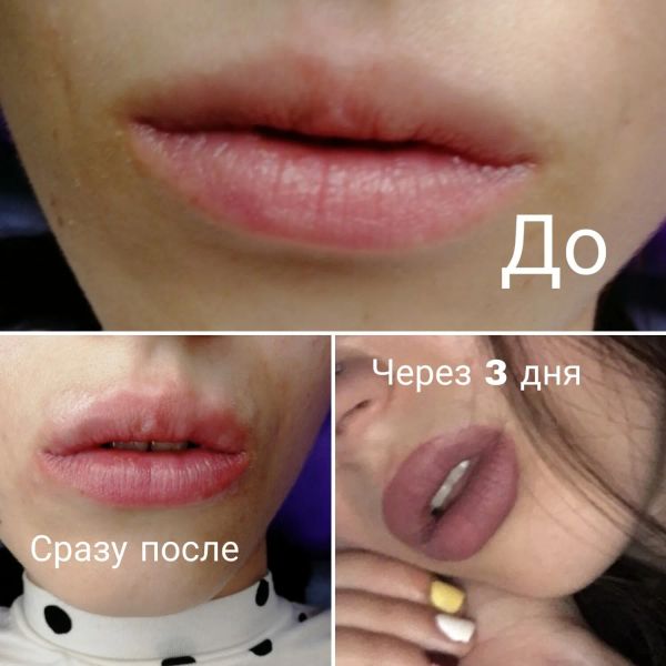 Увеличение губ филлером Hyafilia 