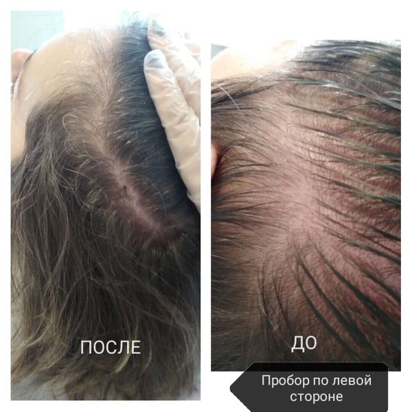 Мезотерапия волос результат после 5 процедуры 