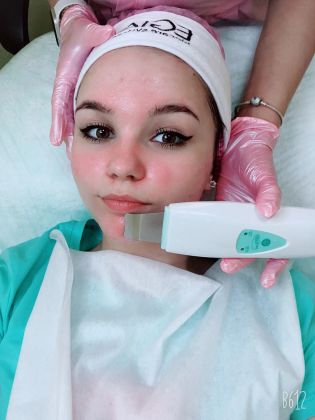 Ультразвуковая чистка лица 