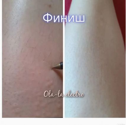 Финиш э/э голени??