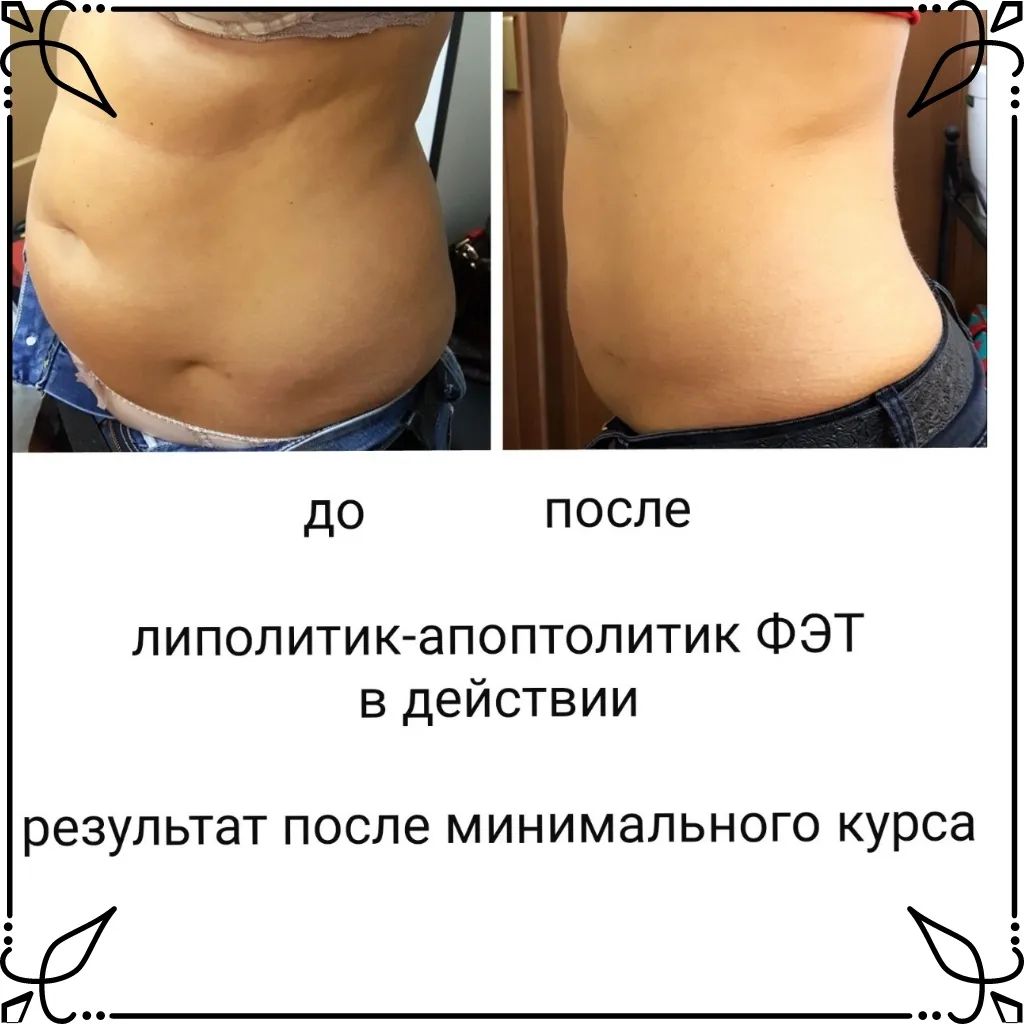 Мезотерапия Тела Для Похудения Отзывы Фото