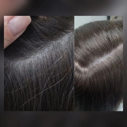 КОРОЧКИ, ПЕРХОТЬ, ЗУД?

Месяц назад ко мне пришла девушка, которую беспокоил сильный зуд, перхоть, корочки с которыми она никак не могла справиться ни сама ни дерматолог ничего толком ей не говорил, что делать чем мазать, как успокоить этот бесконечный зуд.
Скинул все на её диагноз. 

Аня рассказала что у неё сахарный диабед, беда пришла не одна (покрылись корочкой стопы и кожа головы)
Чем только она не пользовалась, ничего не помогало.

Решила прийти на пилинг к трихологу-эстетисту, т.е ко мне.

Я посмотре