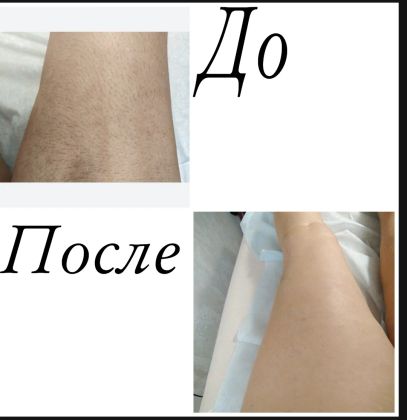 Были очень жесткие волоски и мы все начисто убрали.