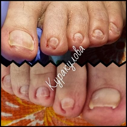 Ониходистрофия, вросшие ногти, подногтевые мозоли.
Выполнен аппаратный педикюр с глубокой обработкой околоногтевых пазух. Тампонада.
Рекомендации по домашнему уходу даны