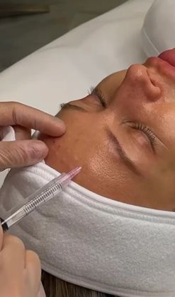 Мезотерапия 