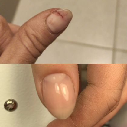 Восстановление ногтей 
