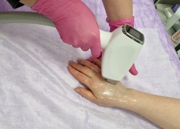 Лазерное омоложение кистей рук 