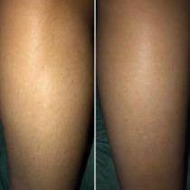 Эпиляция ног воском,фото до и после