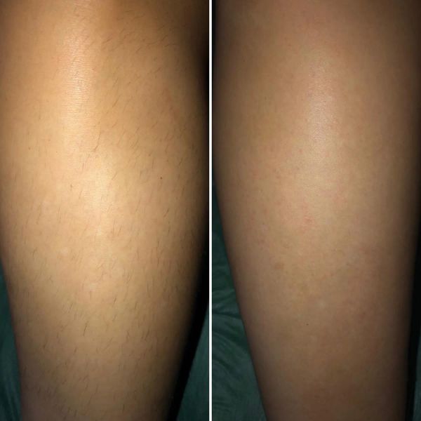 Эпиляция ног воском,фото до и после