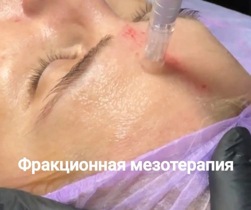 Микронидлинг по сыворотке. Уникальная процедура 2в1.