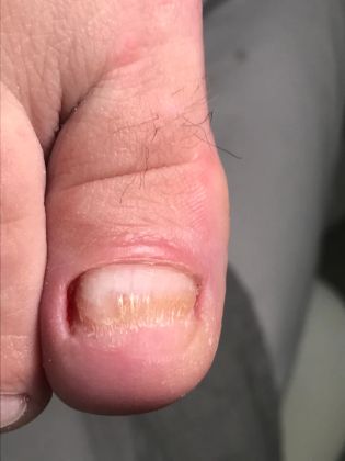 Обработка и восстановление ногтей от онихомикоза (грибковых поражений).