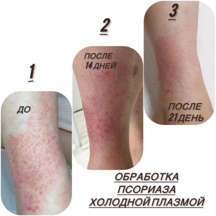 Лечение псориаза