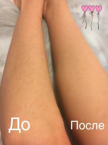 Эпиляция тёплым воском голень ( До и После)