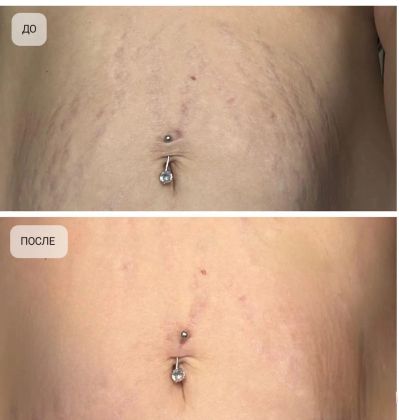 Удаление старых растяжек с помощью процедуры Микроиголчатый рф лифтинг 