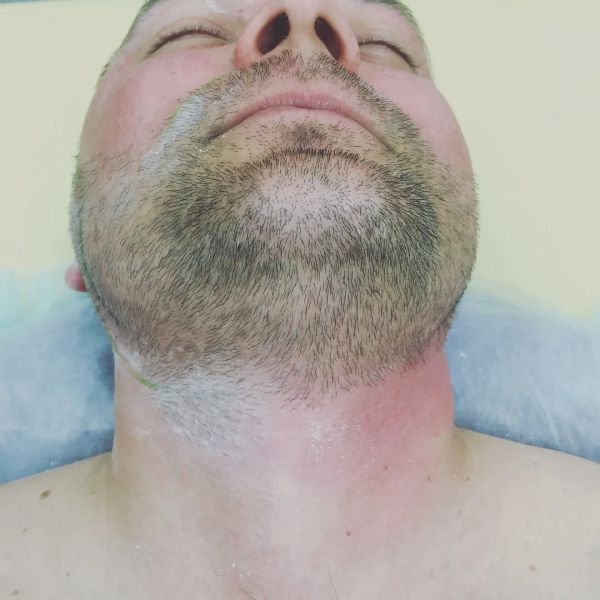 Показана процедура до и после шугаринга, борода, шея