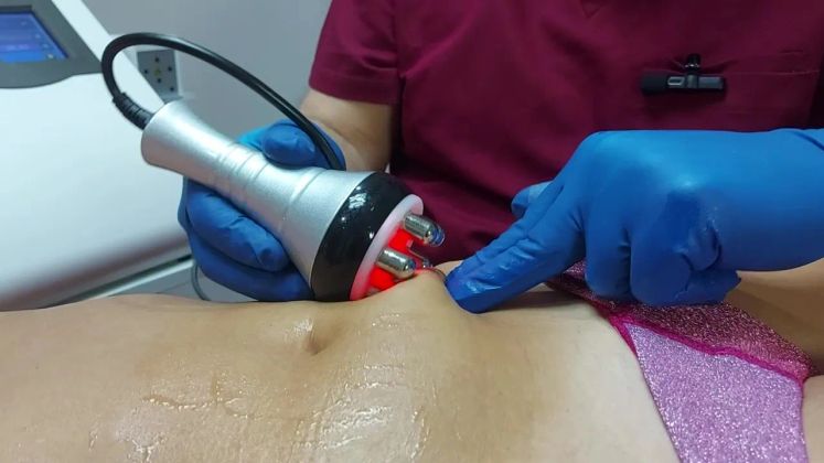 RF-лифтинг тела