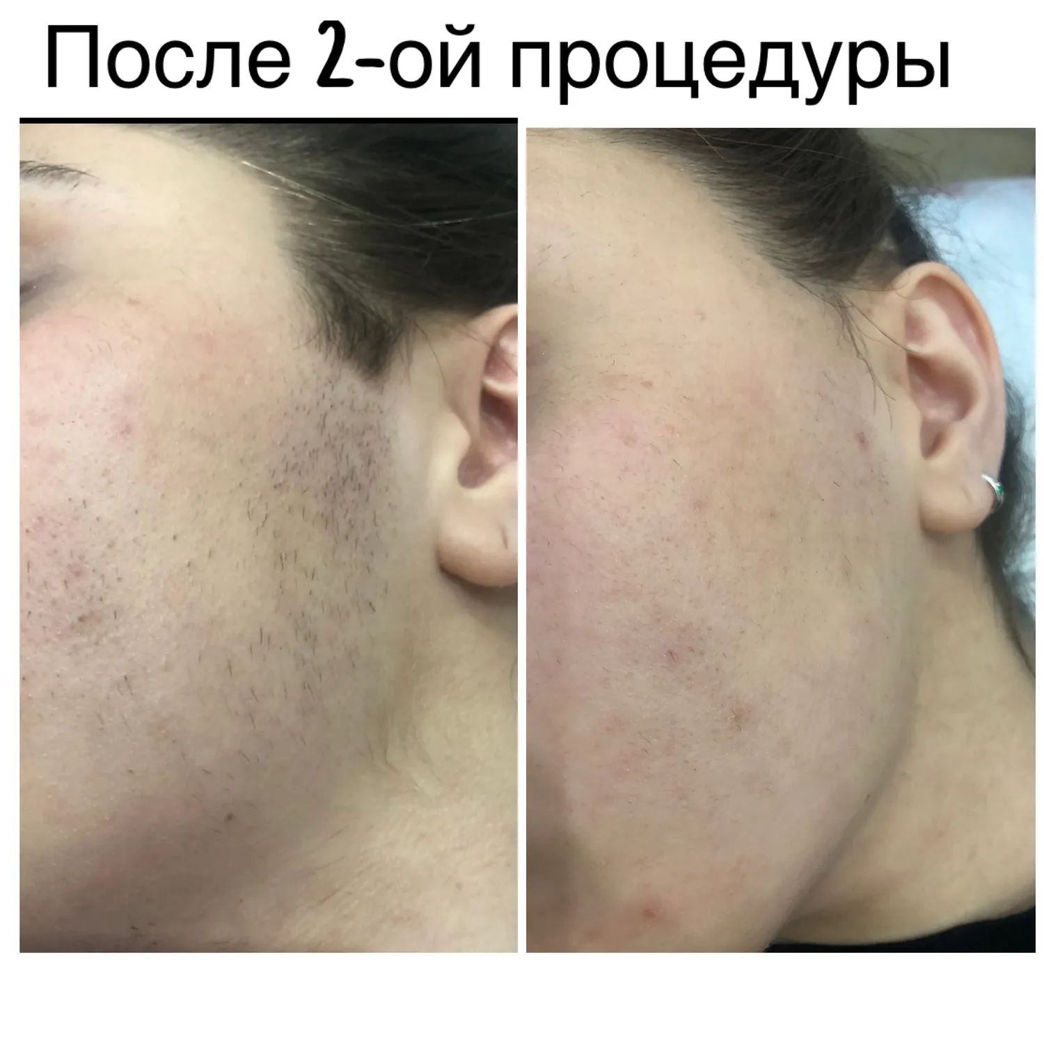 Сколько Стоит Депиляция В Москве