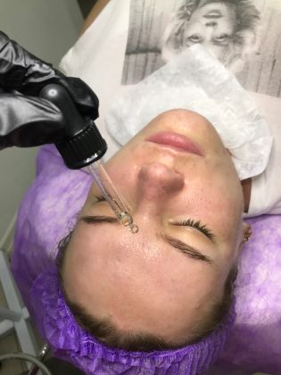 После чистки наносится поверхностный азелаиновый пилинг в целях антибактериального, регенерирующего, антикуперозного и отбеливающего эффекта. Стоимость отдельной процедуры данного пилинга 2800р. (Этот этап входит в стоимость комбинированной чистки?)