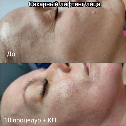 Сахарный лифтинг лица 10 процедур + Кислородное преображение 3 процедуры. Интервал между массажем - 2 дня, между процедурами карбокси - 5 дней. Стоимость курса 11900р