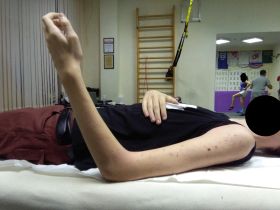 Пациент после перелома головки лучевой кости. 
Фото после 1-го занятия.  