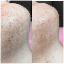 Результат между процедурами (прошло 2 недели). Электроэпиляция – метод удаления волос НАВСЕГДА!