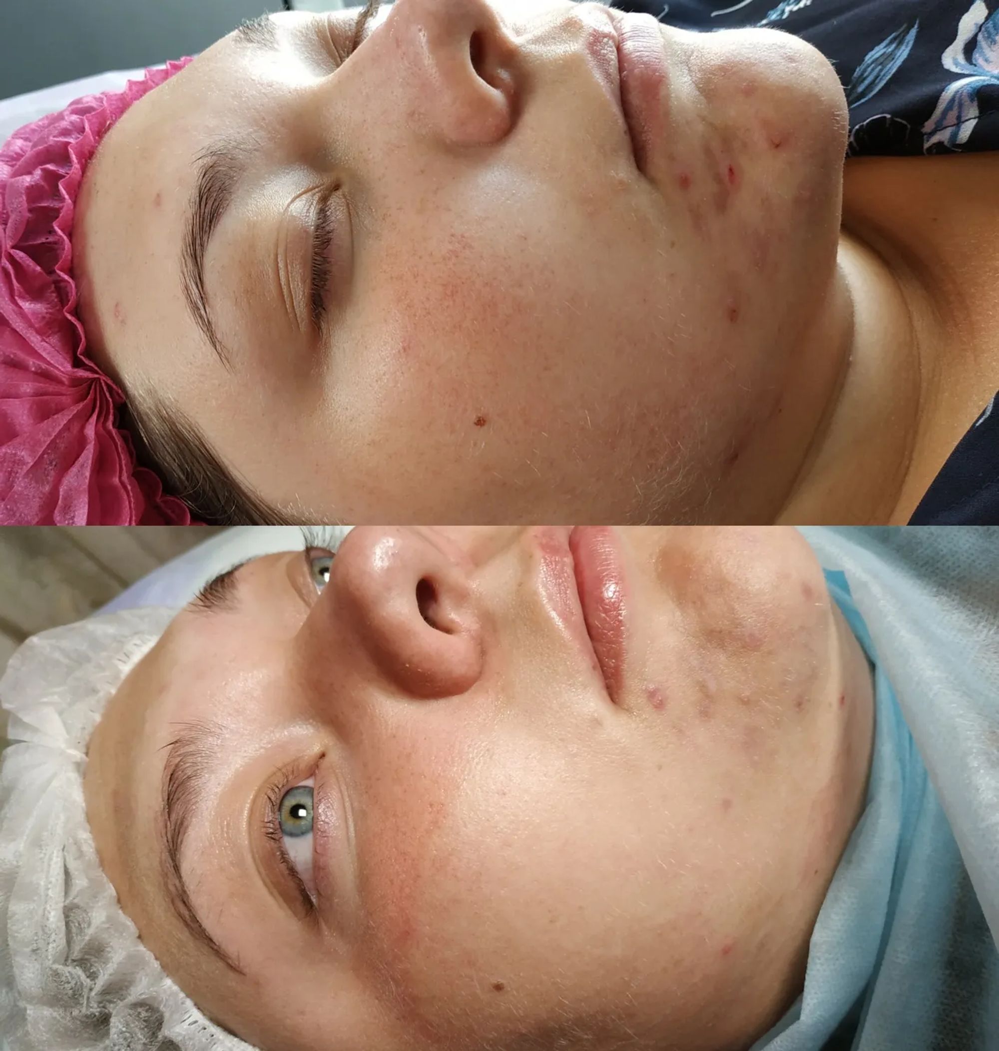 фото до и после мезотерапии тела