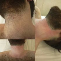 Мужская эпиляция, удаление волос с шеи, выравнивание по груди и оформление бороды, на коллаже фото до и сразу после