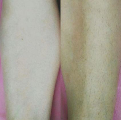 Ножки до и после депиляции