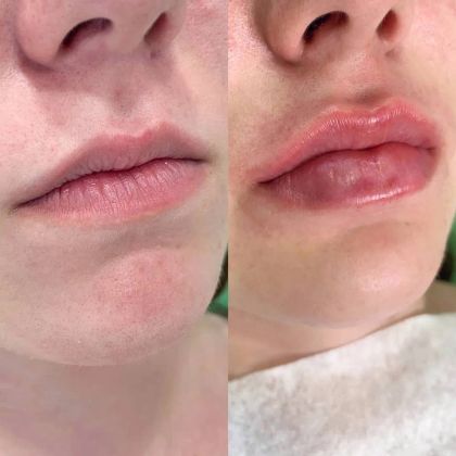 До и после увеличения губ