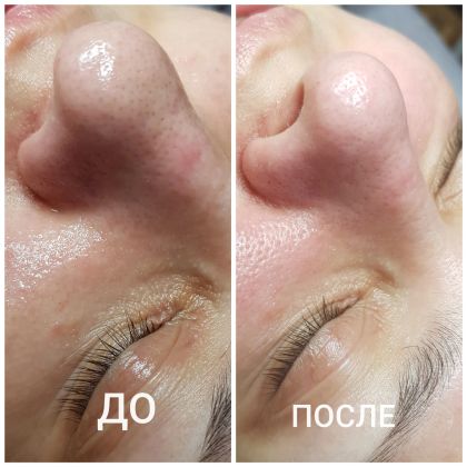 Комбинированная чистка лица плюс пилинг по типу кожи