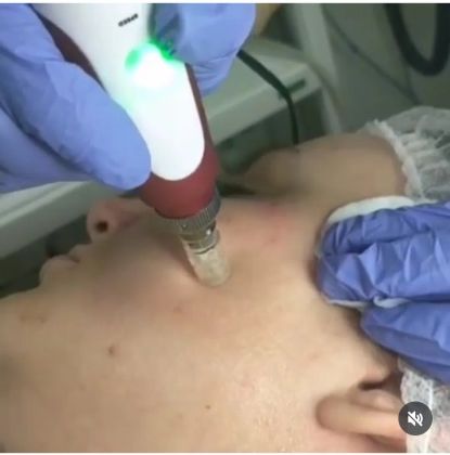 Мезотерапия лица