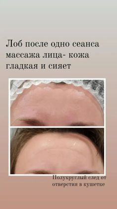 Морщинки разглажены, кожа сияет. Результат после первого сеанса 