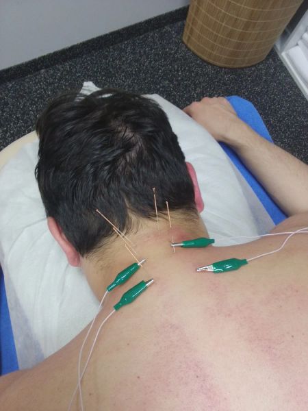 Электроакупунктура при шейном остеохондрозе, сопровождающимся болью 