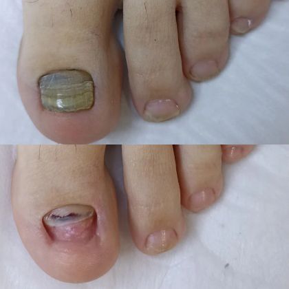 Обработка травмированного ногтя