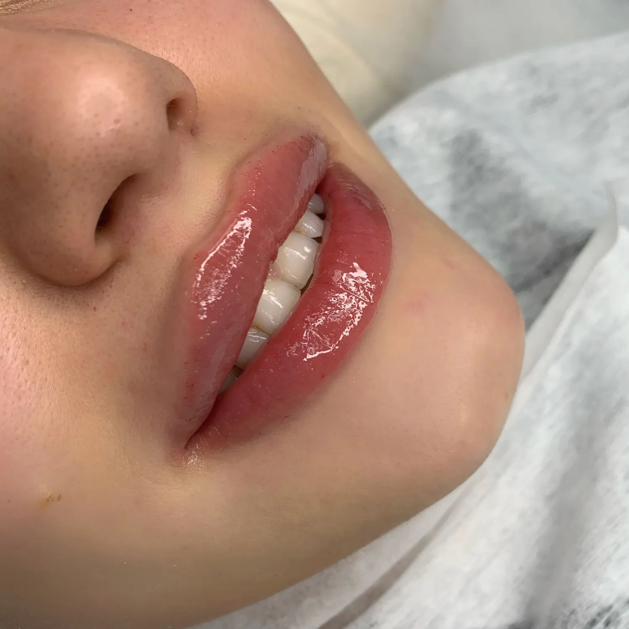 Красивые губы гиалуроновой
