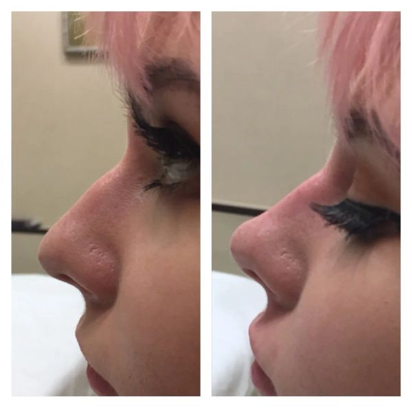 Коррекция кончика носа