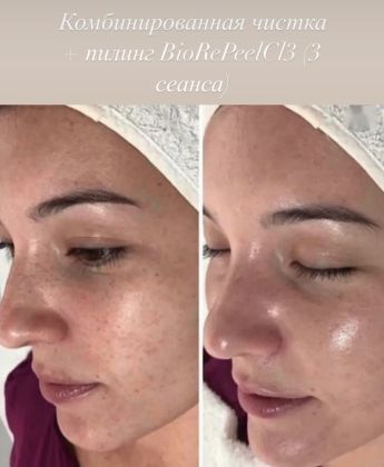 
? BioRePeelCl3 - инновационный двухфазный препарат, обладающий биостимулирующим, ревитализирующим и пилинг эффектом? ? 

?Уникальность препарата в том, что он наносится и действует, как пилинг, но при этом дает эффект биоревитализации. Этот эффект достигается тем, что перед нанесением на кожу две фазы (липофильная для увлажнения и гидрофильная для омоложения) смешиваются и далее работают одновременно, усиливая эффект друг друга. ? 

?Действие препарата BioRepeelCl3: 

1. Стимулирует активность фибробластов