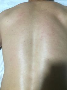 Проведена мужская эпиляция спины
