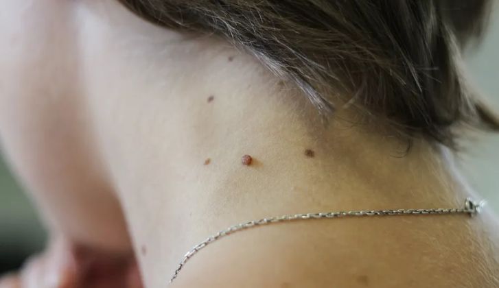 Удаление папиллом на теле 