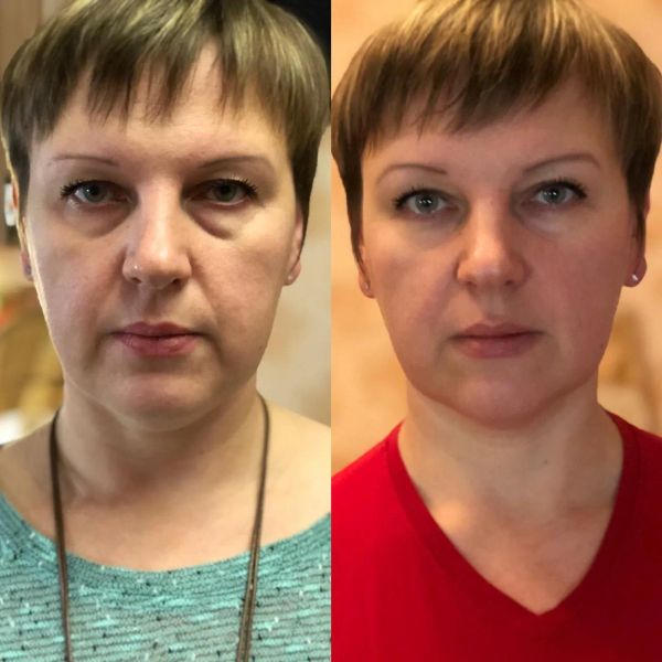 До и после 15 дней массажа