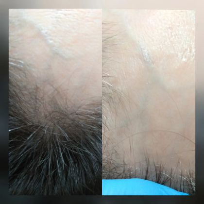 Мезотерапия волос. Укрепление своих волос, питание кожи головы, сокращение выпадения волос, восстановление густоты и роста волос. Курс индивидуален.